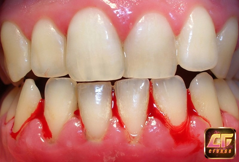 Mộng thấy răng chảy máu thường mang điềm báo không tốt